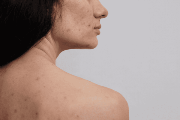 Natural Homemade Remedies For Back Acne