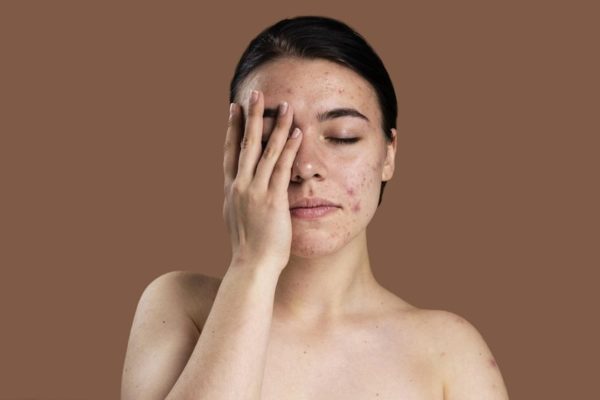 Skin Barrier: What Is It & How To Keep It Strong