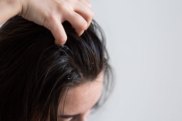 How to Avoid Dry and Itchy Scalp during Winter Season